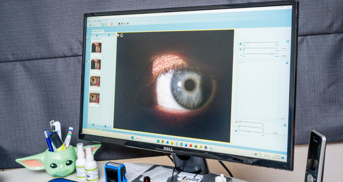 Tonometry and Biomechanics of the Cornea in Contact Lens Wear
