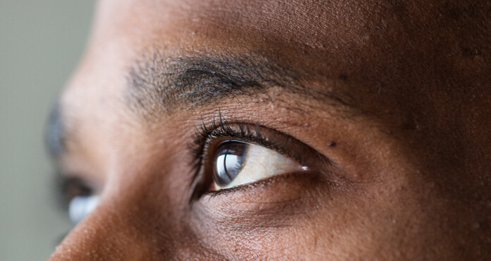 A Non-Surgical Approach to Acute Corneal Hydrops in Optometric Practice