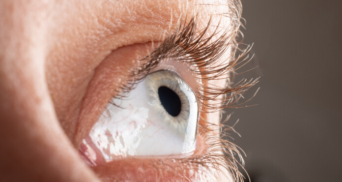 Case Report: Managing Pellucid Marginal Degeneration and Keratoconus with Corneal and Mini-Scleral Lenses