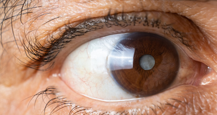 Case Report: A Mini-Scleral Lens for Visual Rehabilitation of Corneal Leukoma Adherens