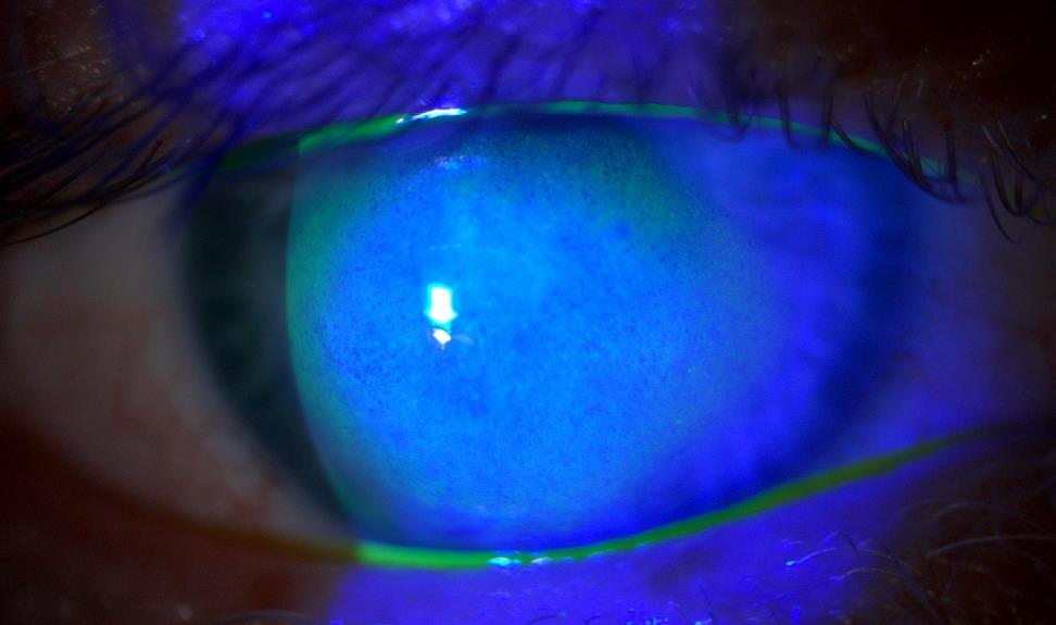 Keratoconic eye with acute corneal hydrops under cobalt blue light with fluorescein