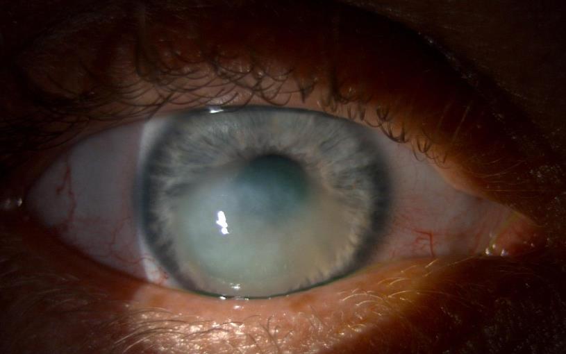 Right eye with acute corneal hydrops - white, oedematous central cornea