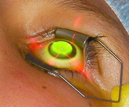 Corneal crosslinking treatment with UV light