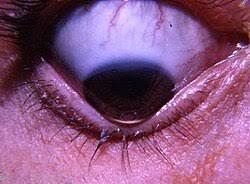 Keratoconus cone seen from below