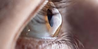 Side view of a cone-shaped keratoconic cornea
