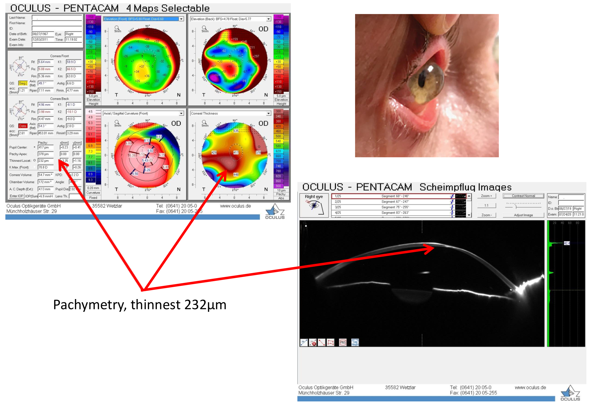 Pentacam maps and Scheimpflug image of a keratoconic eye; pachymetry, thinnest 232 micron