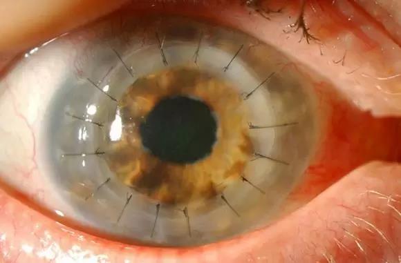 Eye after keratoplasty with corneal sutures