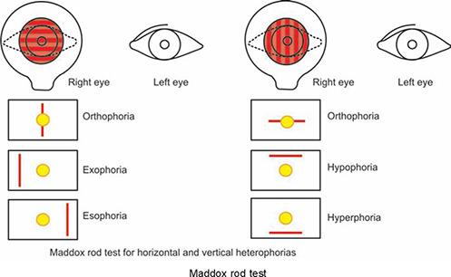 Maddox rod test results for horizontal and vertical heterophorias