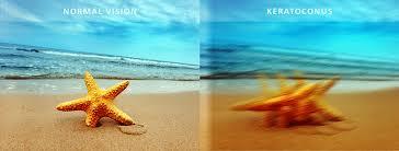 Beach scene seen with normal vision and with keratoconus