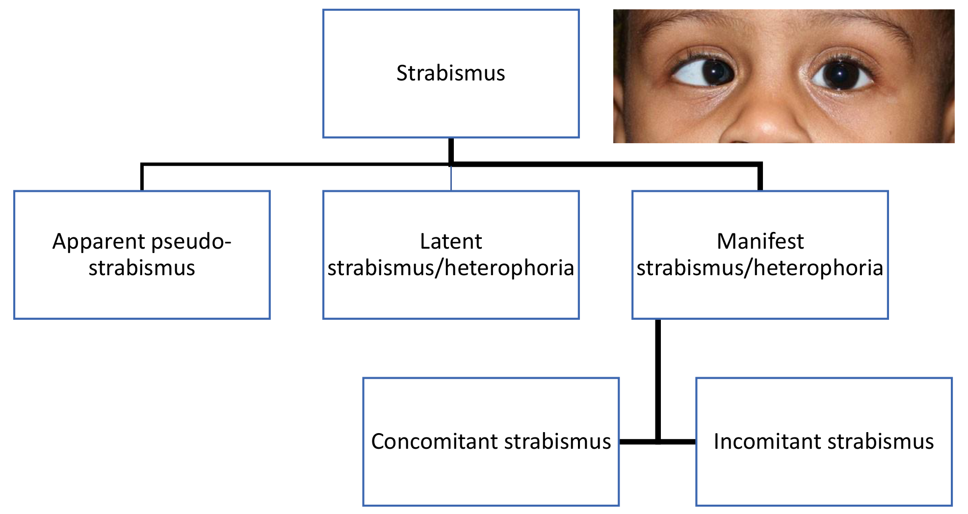 Chart classifying strabismus as apparent, latent or manifest, with manifest split into concomitant and incomitant