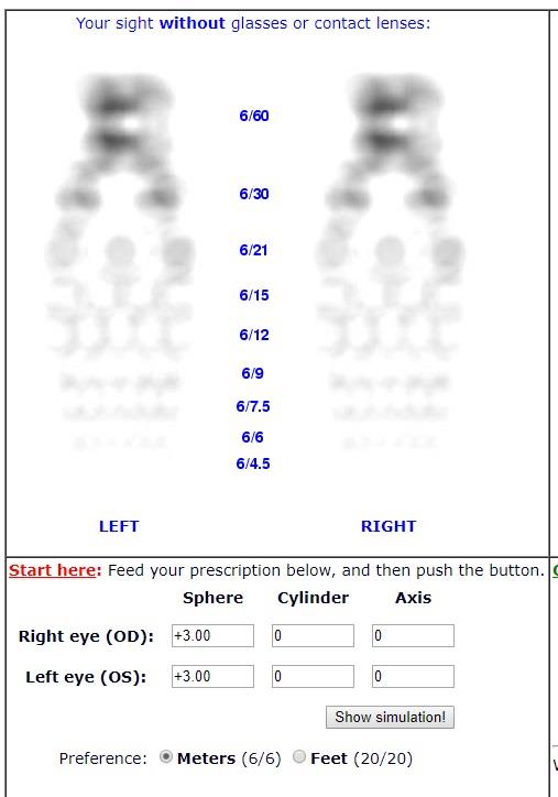 Simulated vision on a Snellen chart without glasses for +3.00 sphere in both eyes