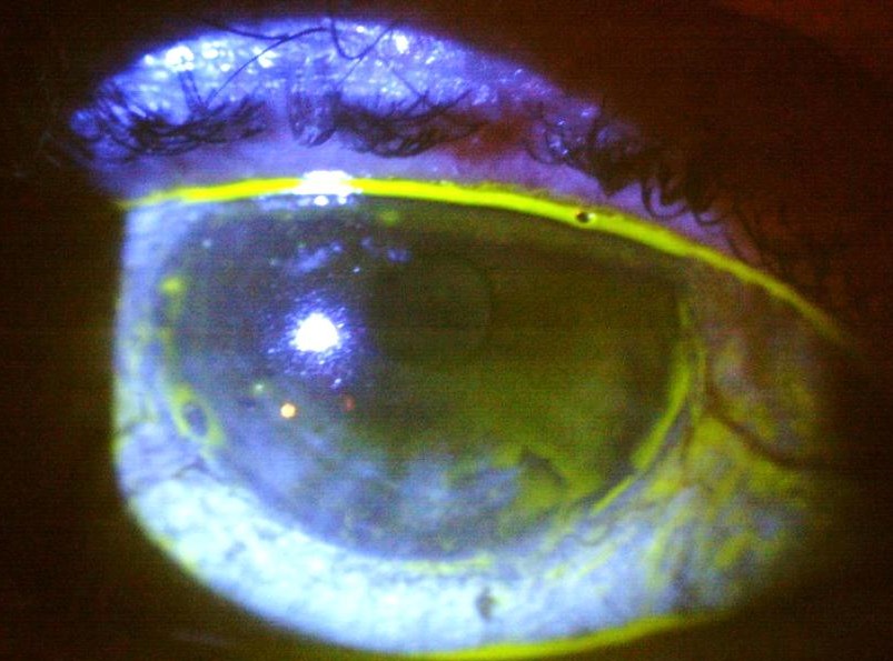 Case 1 - fluorescein staining along the lower lid margin