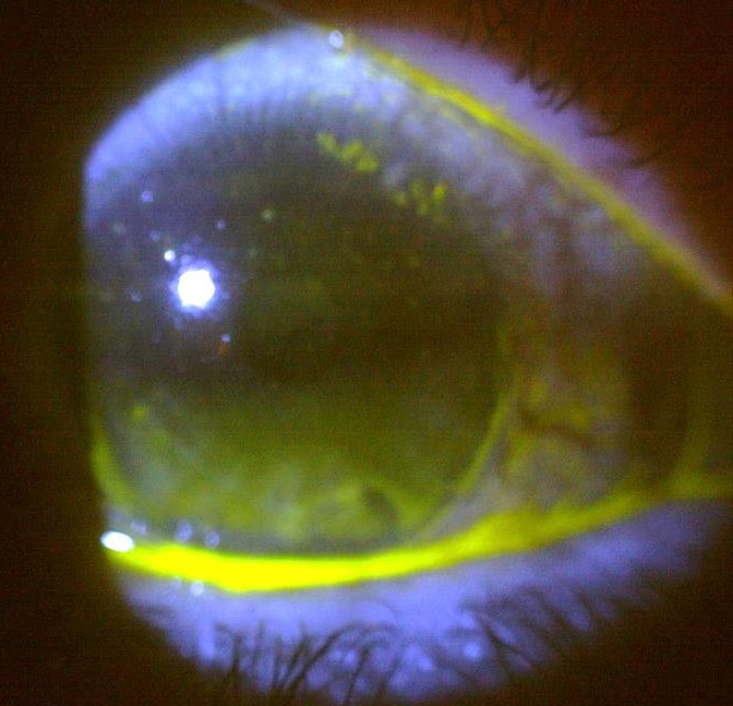 Case 1 - fluorescein staining of the cornea