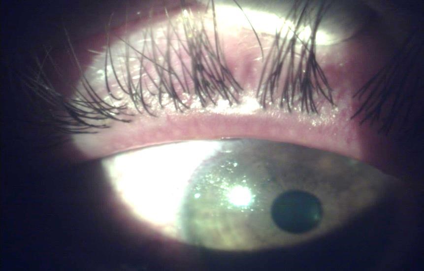 Case 1 - upper lid margin with posterior blepharitis