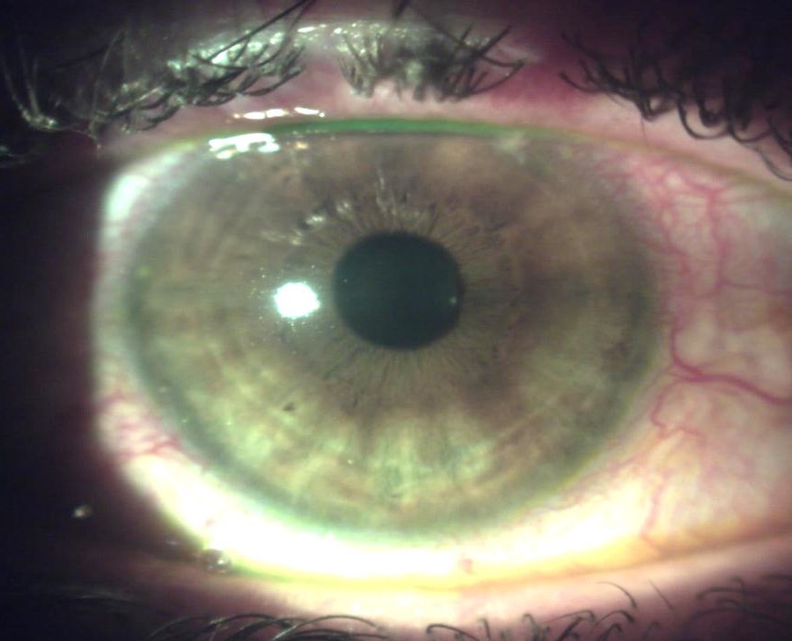 Case 1 - red eye with marginal infiltrates