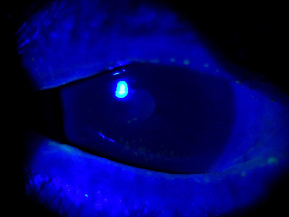 Case 2 - eye under cobalt blue light