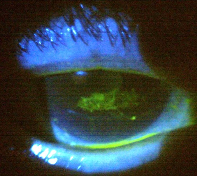 Case 2 - central corneal lesion stained with fluorescein