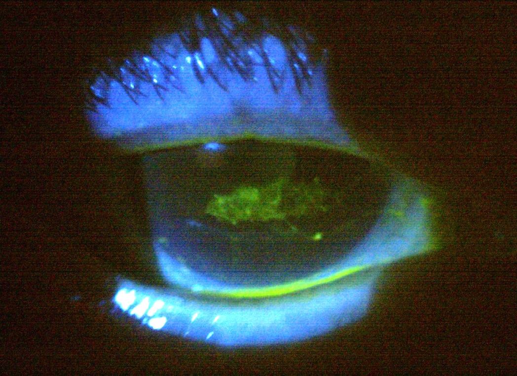 Case 2 - central lesion staining with mucus strands