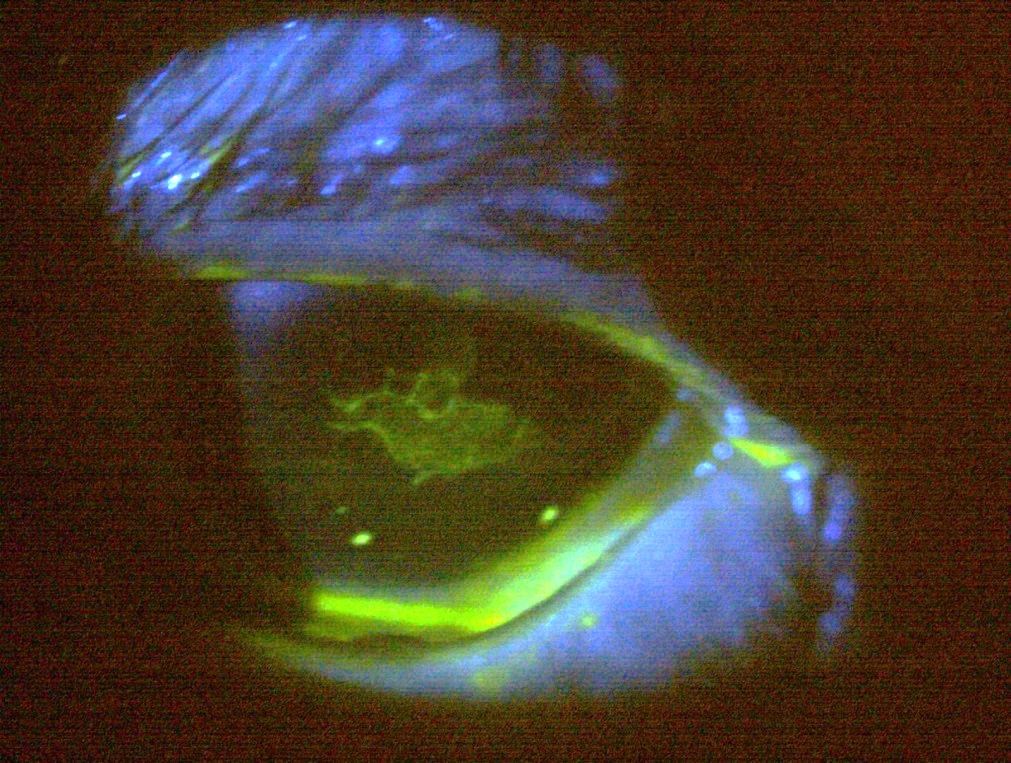 Case 2 - central lesion staining with fluorescein
