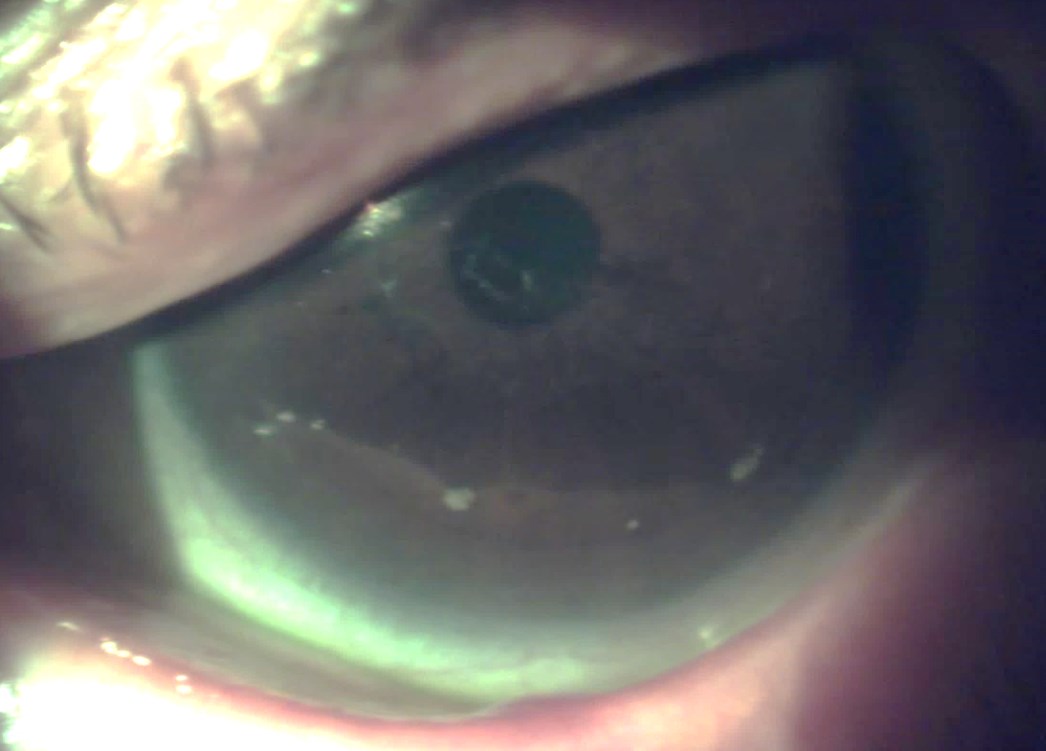 Case 2 - central corneal lesion in white light