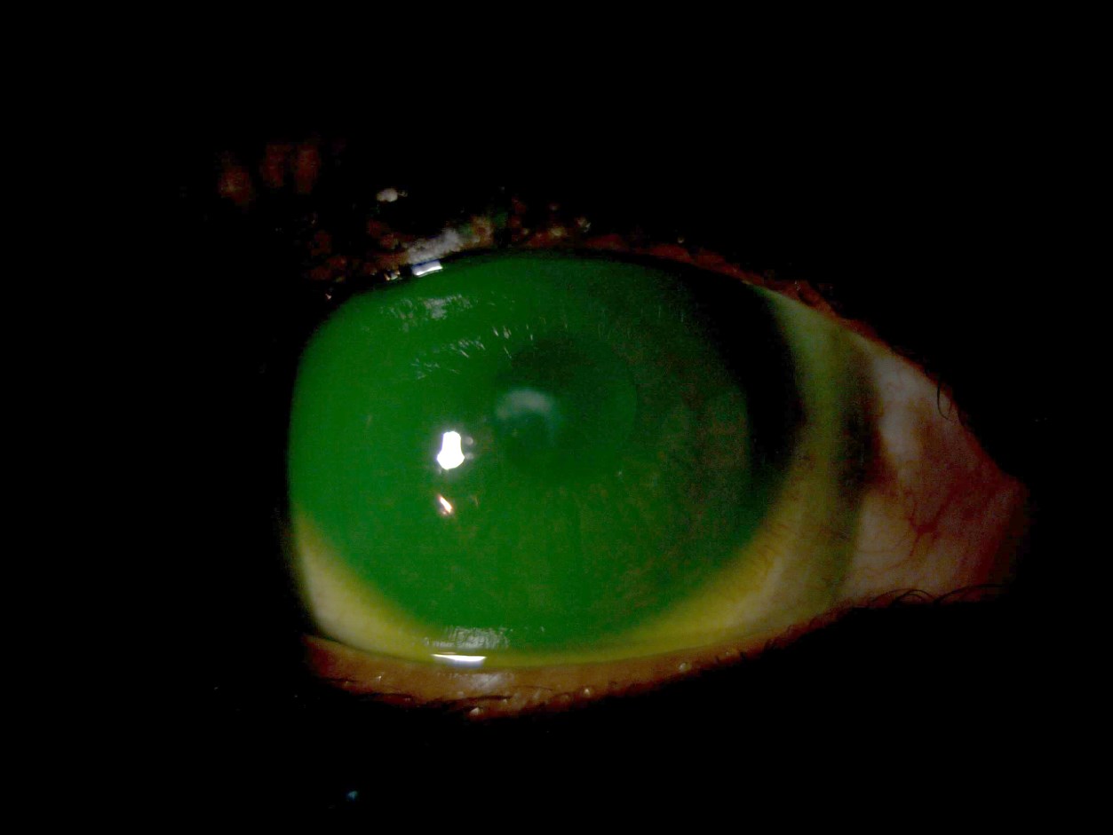 Fluorescein pattern of the final mini-scleral lens on the right eye