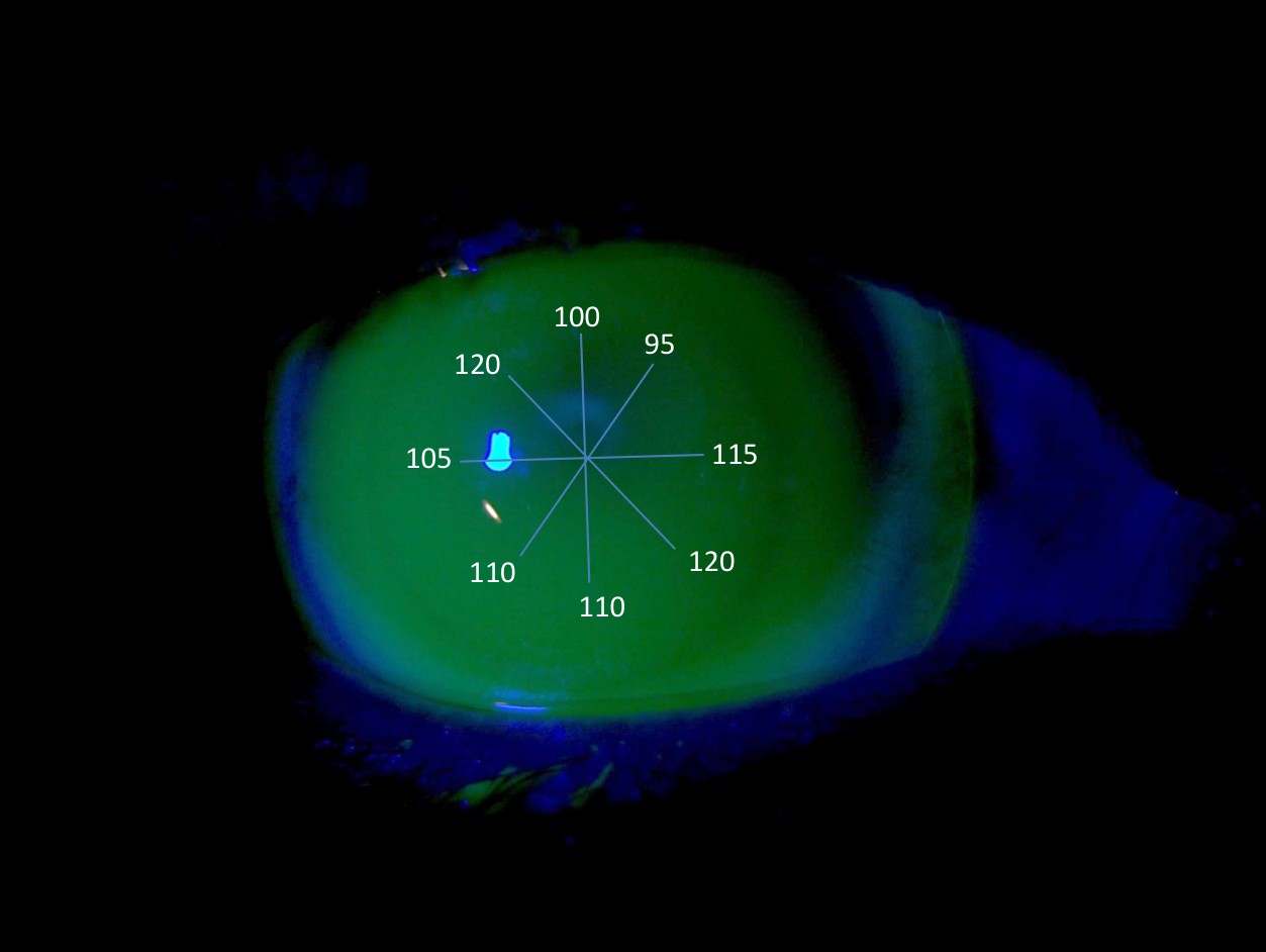 Fluorescein view of the mini-scleral trial lens with estimated clearance values per meridian