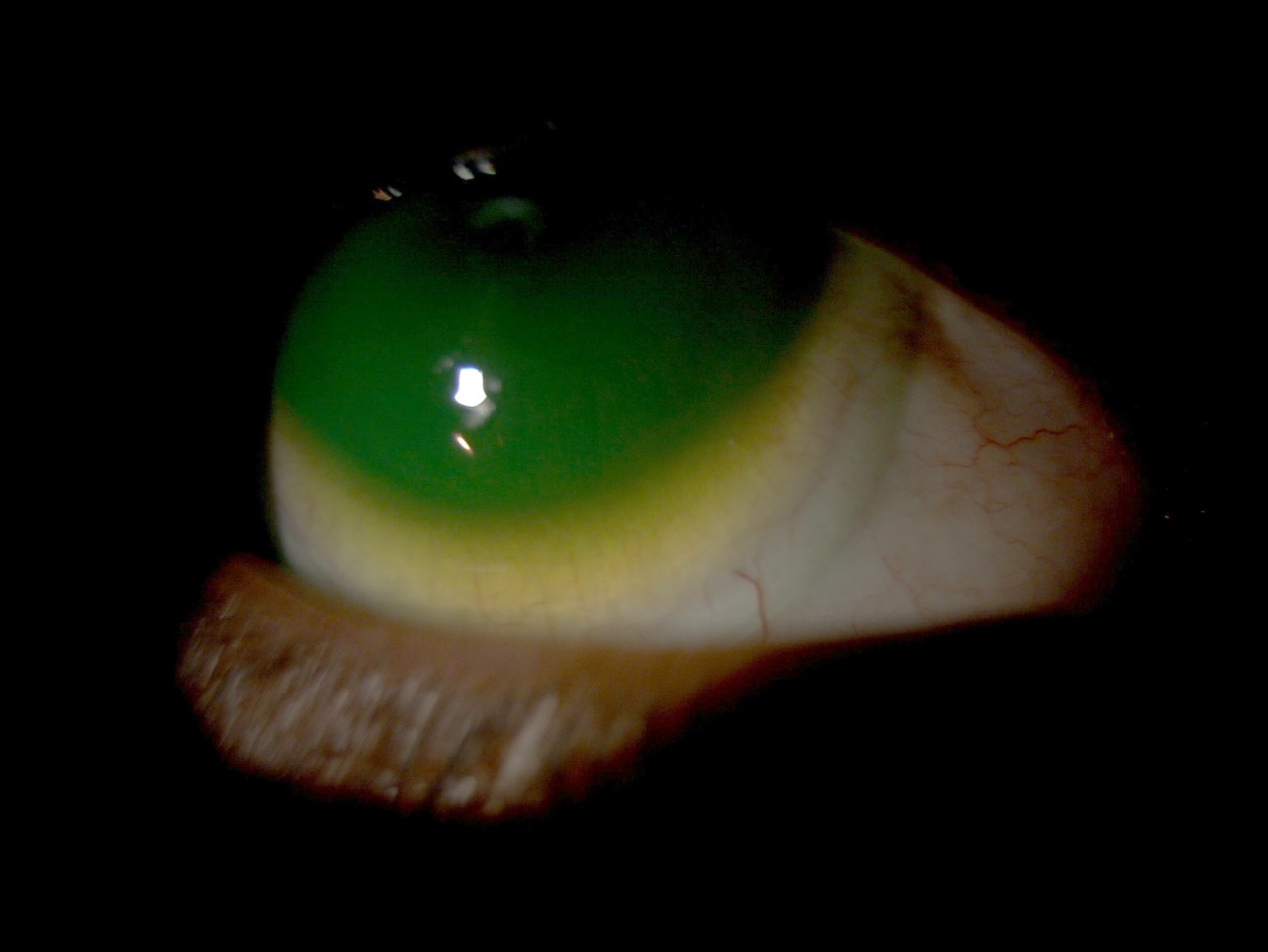 Inferior edge of the mini-scleral trial lens on the right eye
