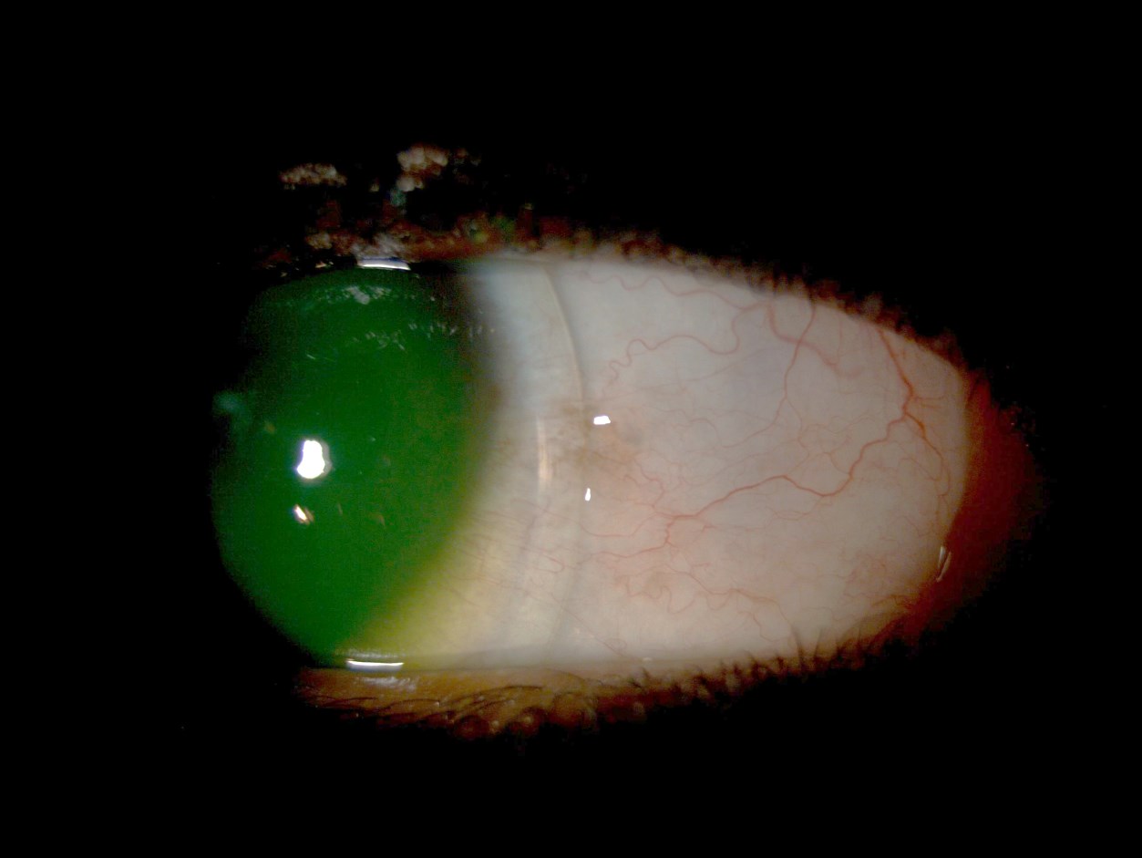 Nasal edge of the mini-scleral trial lens on the right eye