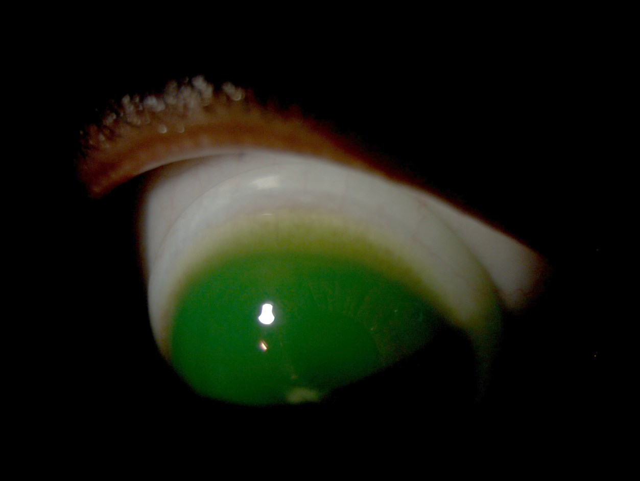 Superior edge of the mini-scleral trial lens on the right eye