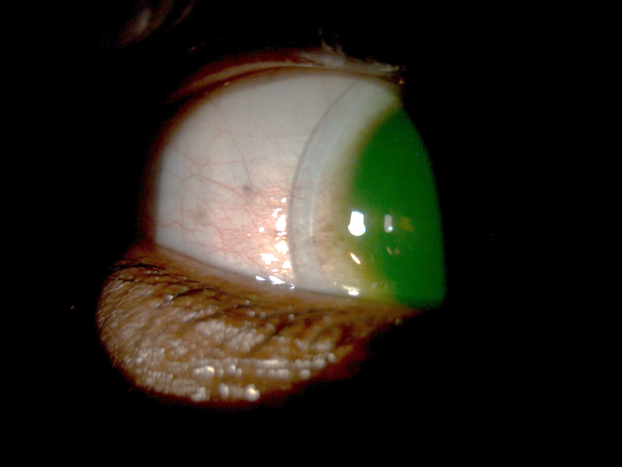 Temporal edge of the mini-scleral trial lens on the right eye