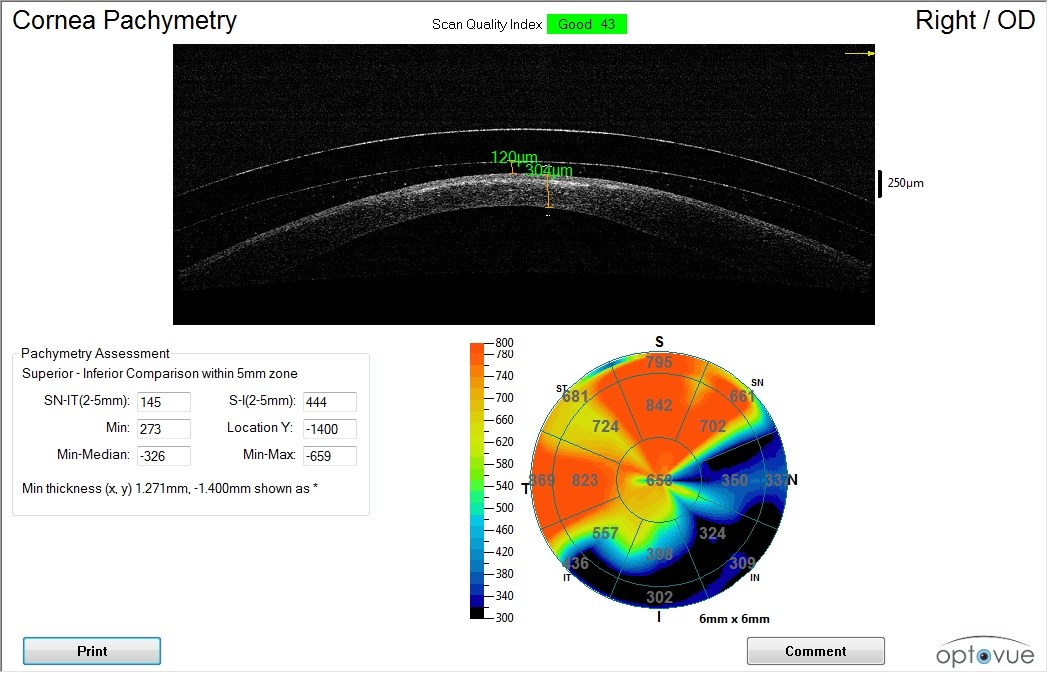 Anterior segment OCT of the final mini-scleral lens on the right eye showing apical clearance