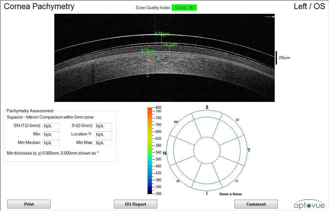 Anterior segment OCT of the left eye with the piggy-back lens system
