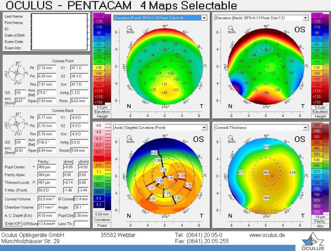 Pentacam 4 maps of the left eye showing the butterfly pattern of PMD