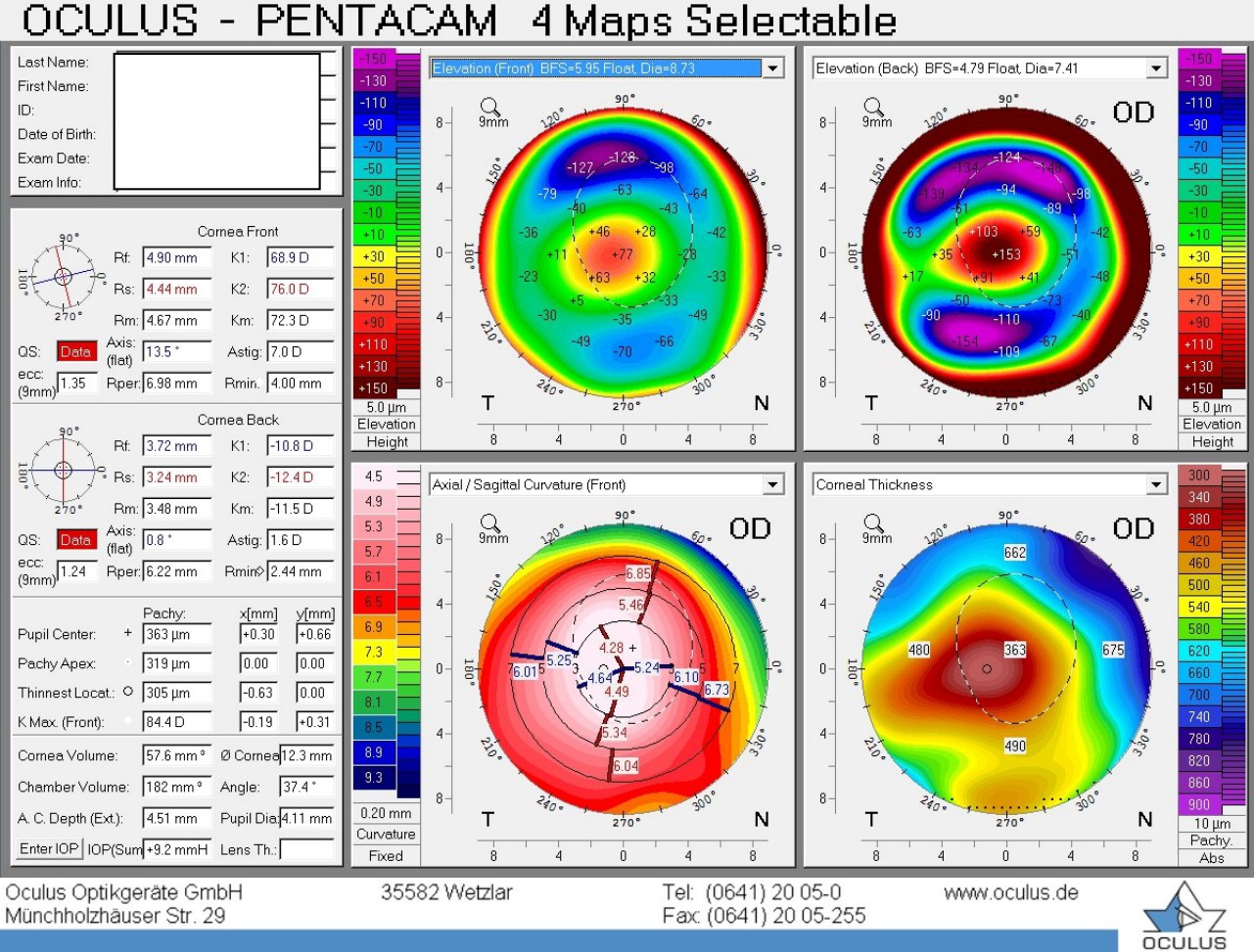 Pentacam 4 maps of the right eye showing central keratoconus
