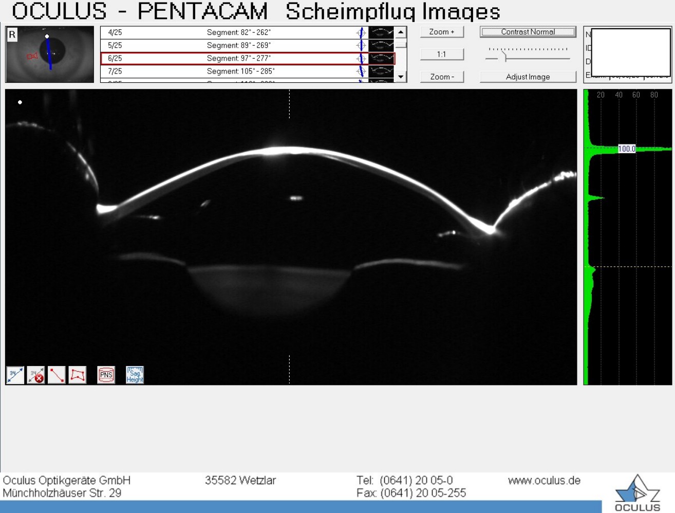Pentacam Scheimpflug image of the right cornea and anterior chamber