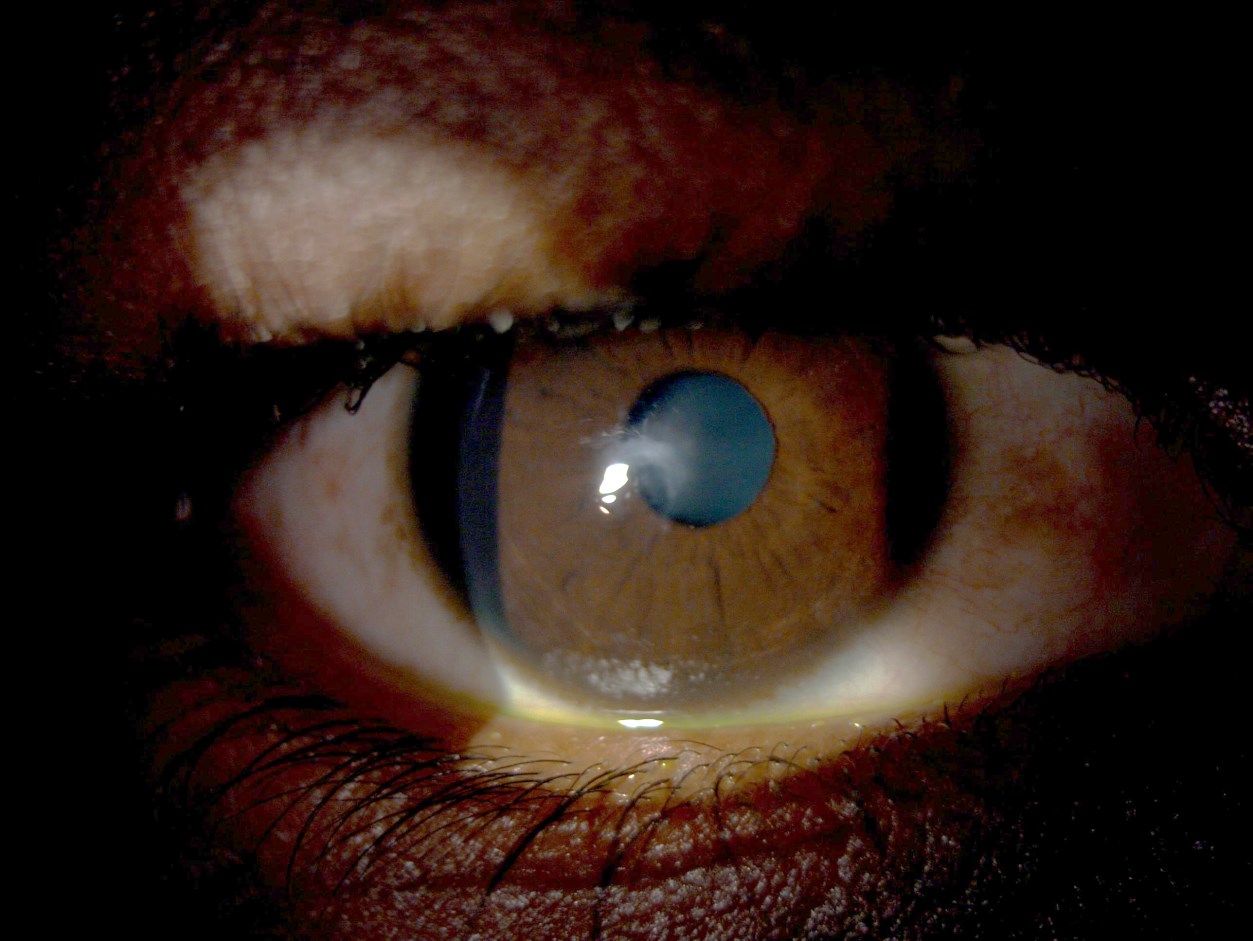 Slit lamp photo of the right eye with a central corneal scar