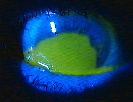 Case 3 - large corneal epithelial defect stained with fluorescein