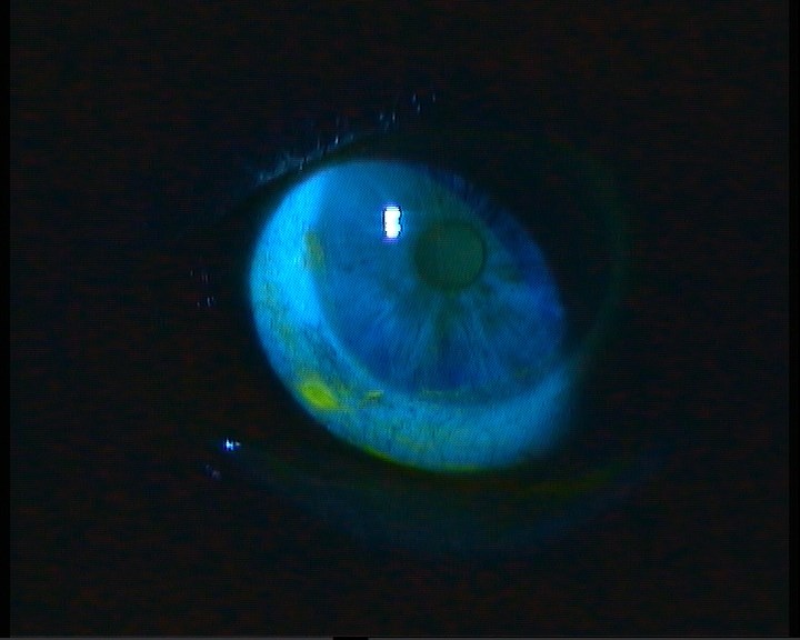 Case 3 - cornea six days after treatment