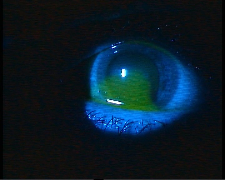 Case 3 - cornea two days after treatment