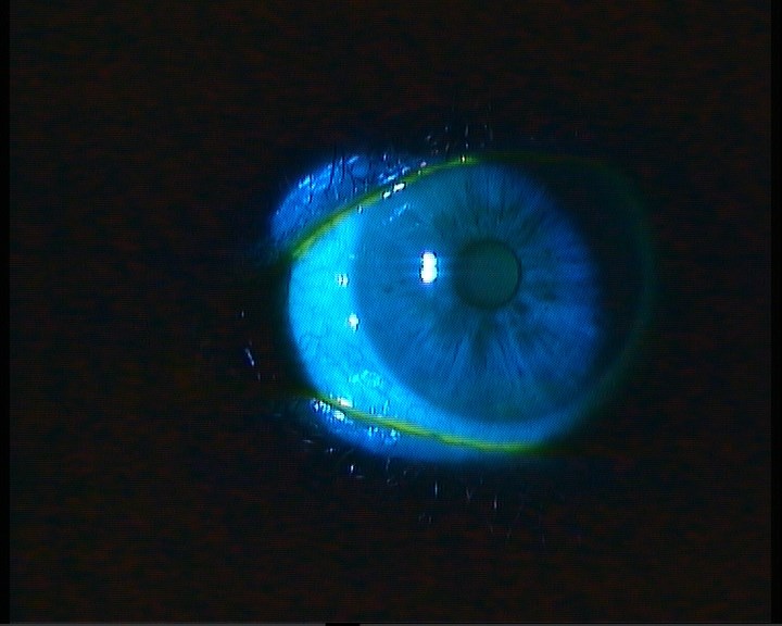 Case 3 - healed cornea