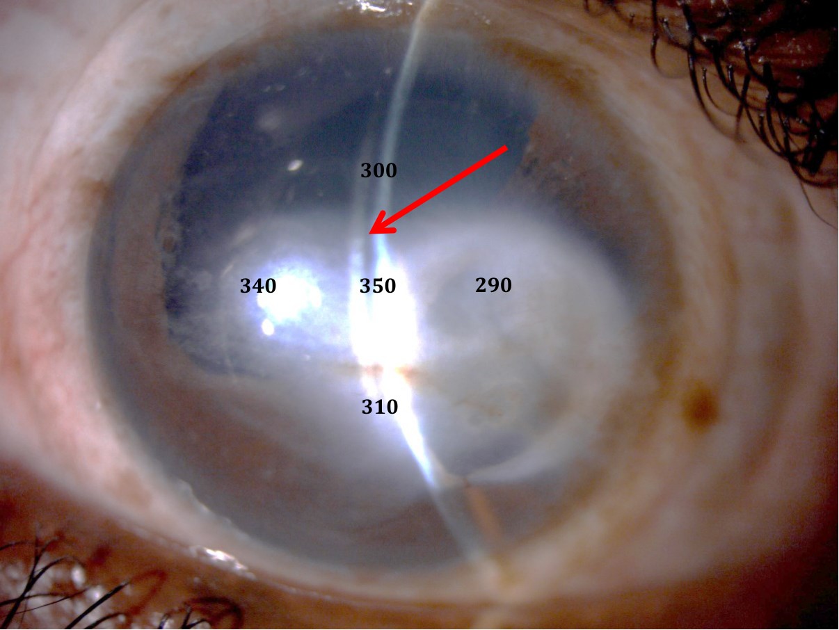 Optic section through the mini-scleral lens on the left eye with clearance values and an arrow at the tear lens