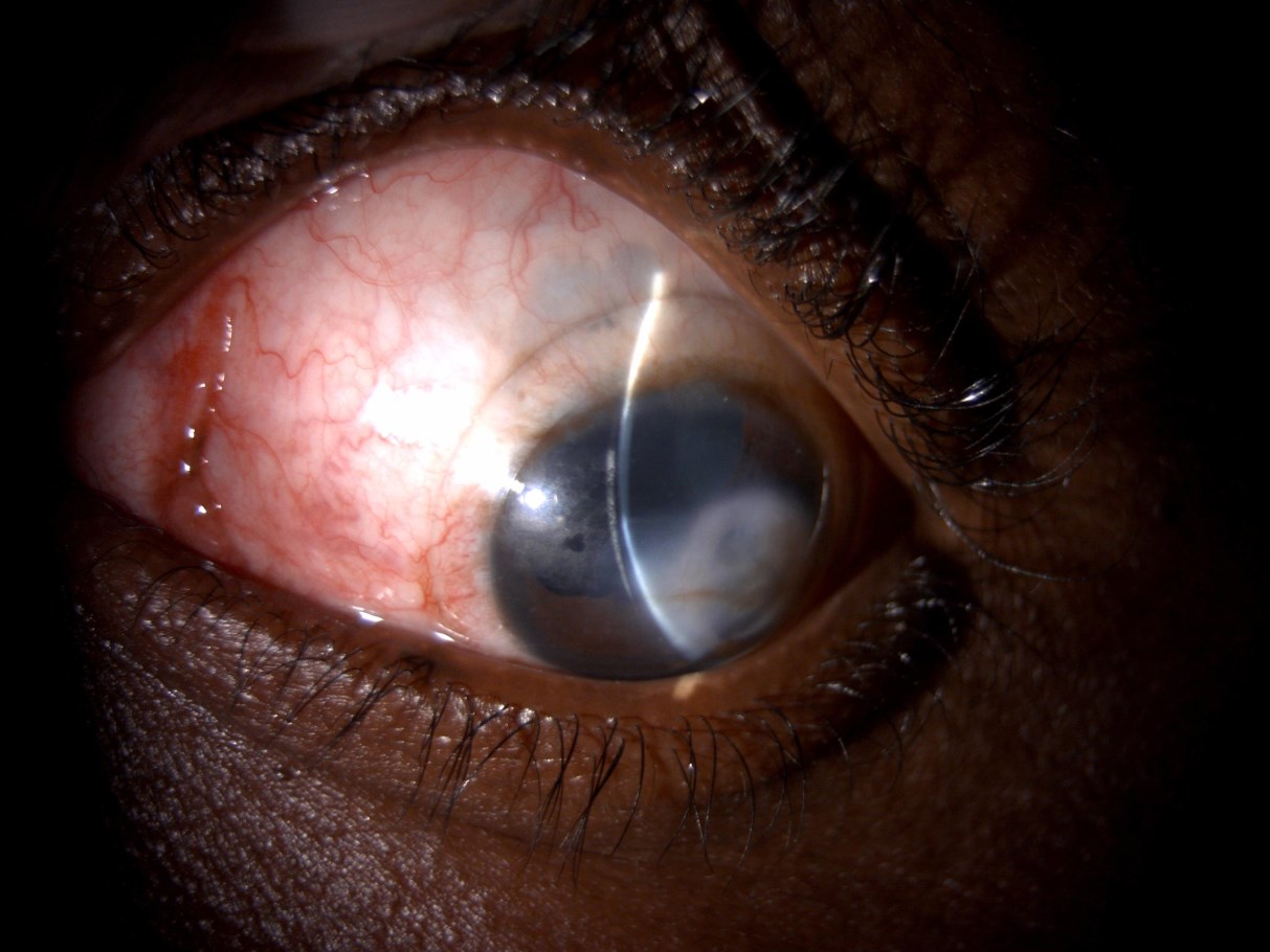 Mini-scleral lens on the left eye in downward gaze