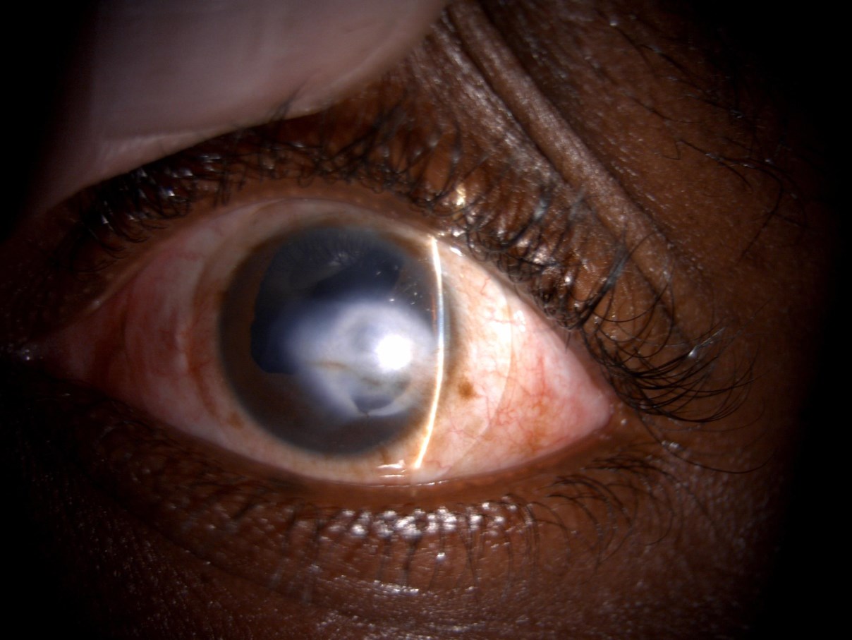 Mini-scleral lens on the left eye without conjunctival blanching