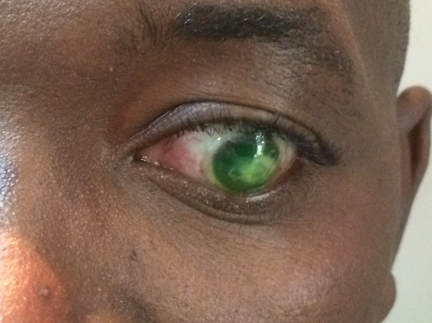 Fluorescein pattern of the mini-scleral lens on the left eye