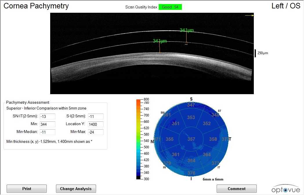 Anterior segment OCT pachymetry showing the apical clearance of the mini-scleral lens on the left eye
