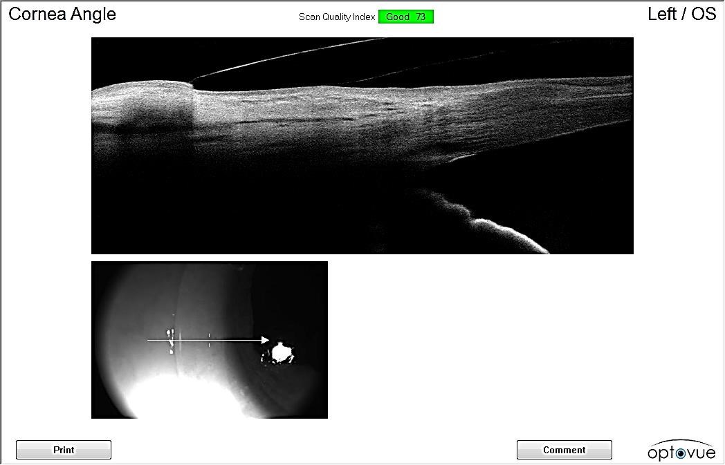 Anterior segment OCT of the nasal edge of the mini-scleral lens on the left eye