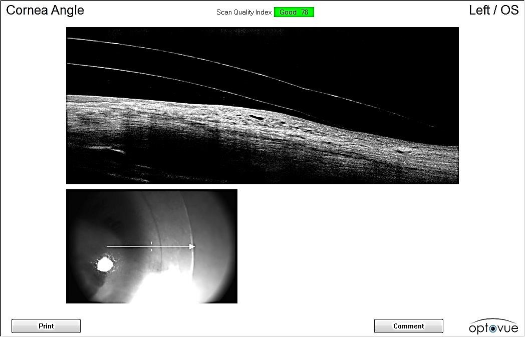 Anterior segment OCT of the temporal edge of the mini-scleral lens on the left eye