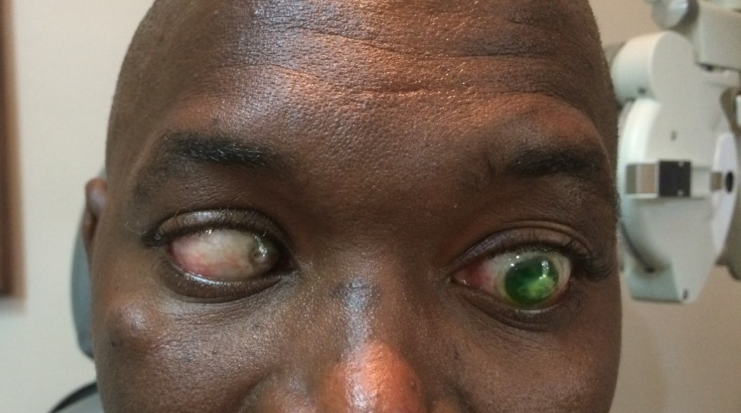 Patient wearing a mini-scleral lens on the left eye, with corneal leukoma in both eyes
