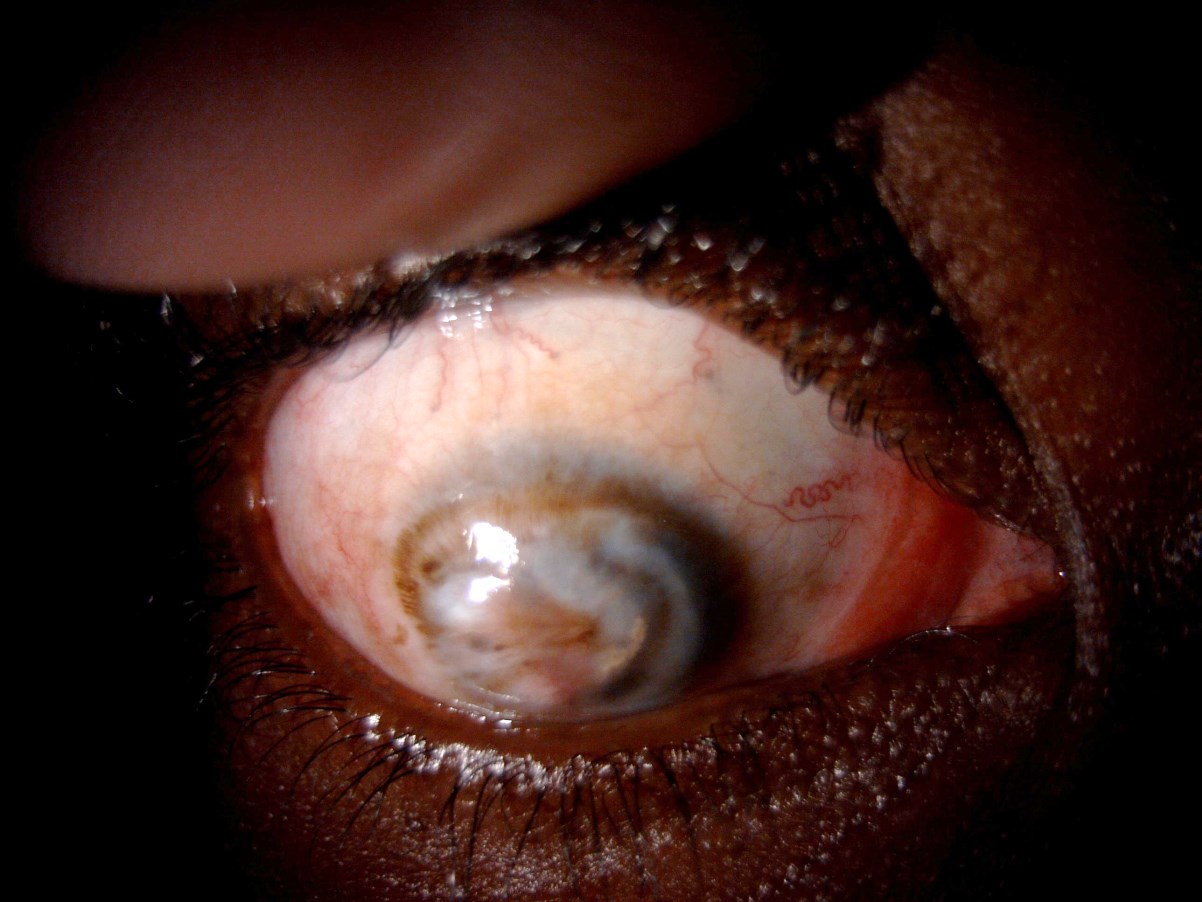Severely scarred vascularised right cornea