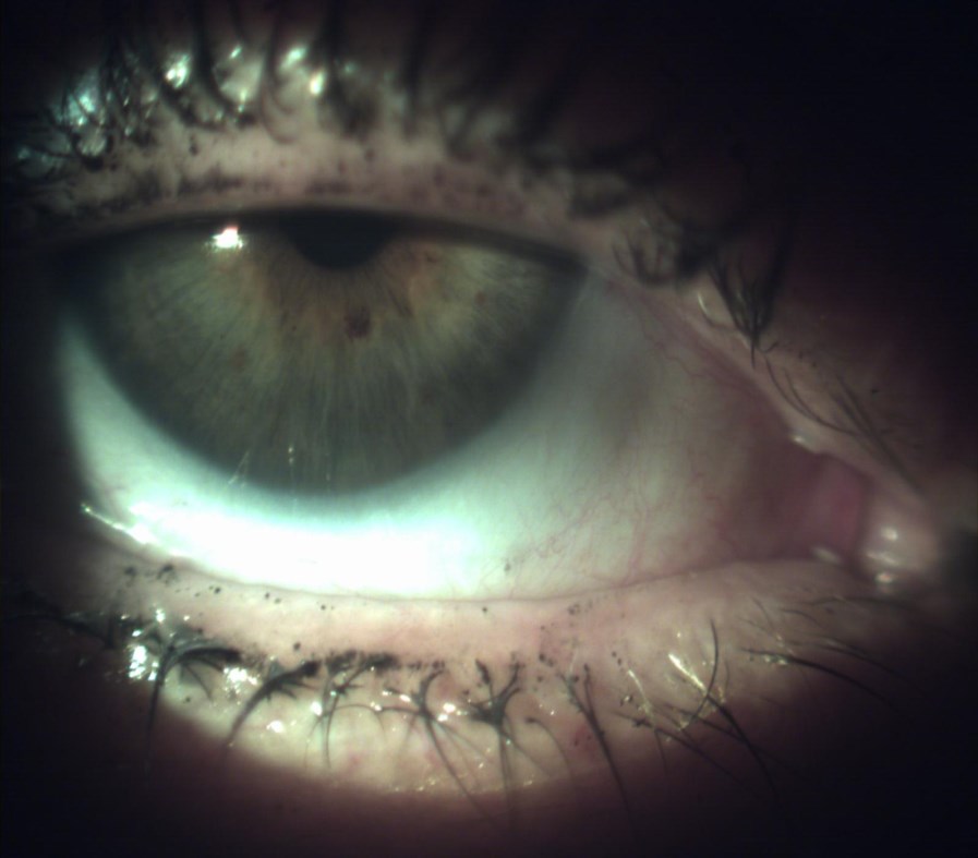Case 5 - eye after two weeks with a bandage lens